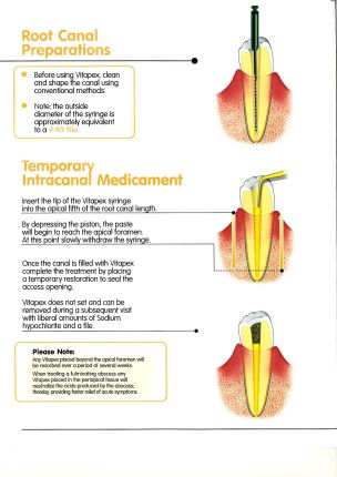 J.Morita Root Canal Filling Vitapex