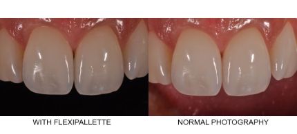 Smile Line Flexipalette (For Intra-Oral Photography)